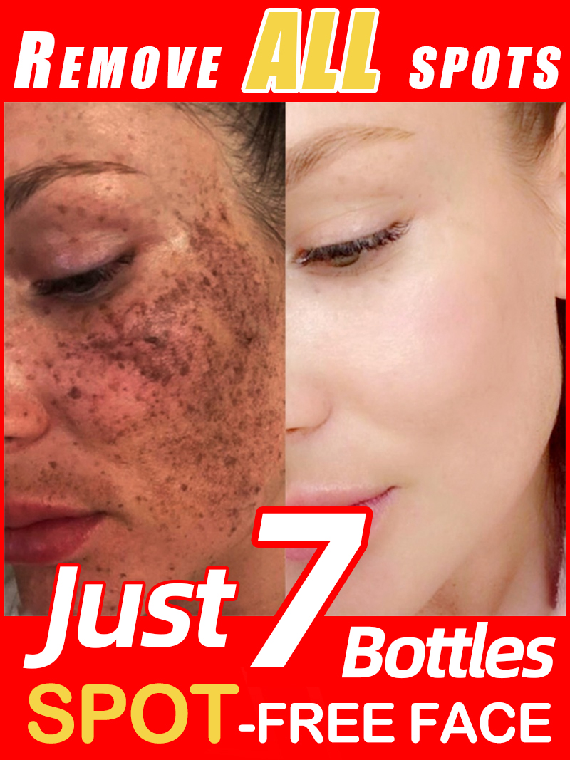 Luxury Natural Skincare - Zmniejszanie piegów, melazmy, ciemnych plam na
